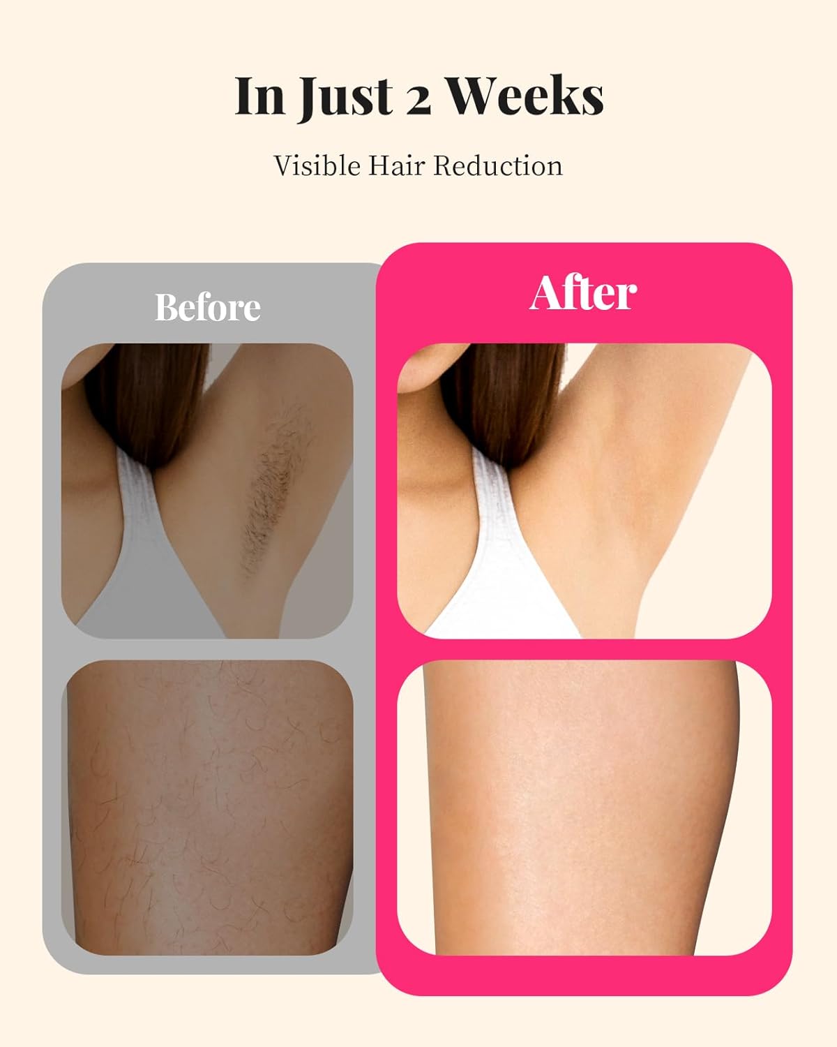 LYSMOSKI IGBT Laser Hair Removal